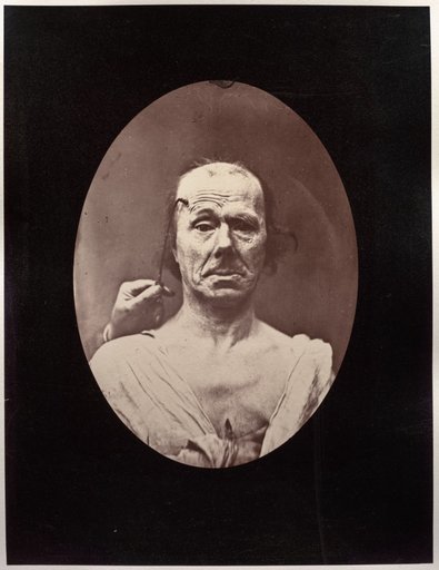 Figure 7: Étude du méchanisme et de l'expression du muscle frontal chez un vieillard: à droit, attention; à gauche, repos