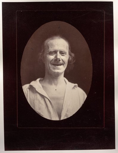 Figure 32: Natural laughter by the voluntary contraction of the two large zygomatics and the lower palpebral orbicularis