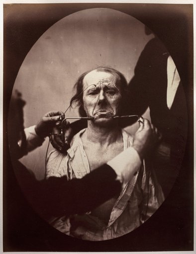 Figure 45: Contraction électrique forte des triangulaires des lèvres et des sourciliers: douleur et déspoir