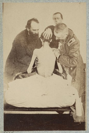 Emaciated prisoner of war from Belle Isle, Richmond, Private Isaiah G. Bowker of Co. B, 9th Maine Volunteers, at the U.S. General Hospital, Div. 1, Annapolis