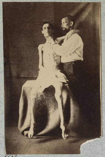 Unidentified emaciated prisoner of war, released from prison at Belle Isle, Richmond, at the U.S. General Hospital, Div. 1, Annapolis
