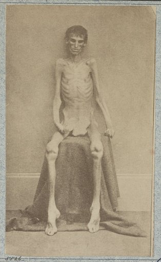 Unidentified emaciated prisoner of war, from Belle Isle, Richmond, at the U.S. General Hospital, Div. 1, Annapolis