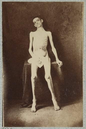 Emaciated prisoner of war from Belle Isle, Richmond, Private William M. Smith of Co. D of 8th Kentucky Volunteers, at the U.S. General Hospital, Div. 1, Annapolis