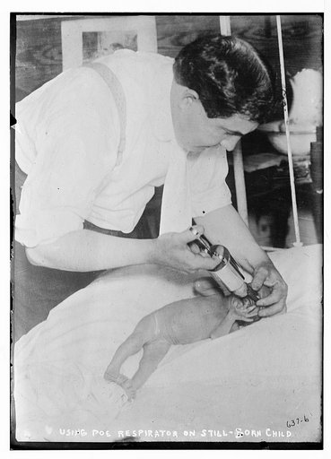 Using Poe respirator on still-born child