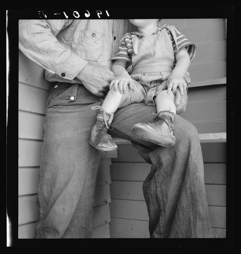 Tulare County. In Farm Security Administration (FSA) camp for migratory workers. Baby with club feet wearing homemade splints inside shoes