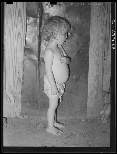 Child of agricultural day laborer living near Tullahassee, Oklahoma. Notice the distended stomach, which is indicative of malnutrution and unbalanced diet with too many starchy foods. This condition is prevalent throughout the tenant farmer and day laboring families in Oklahoma