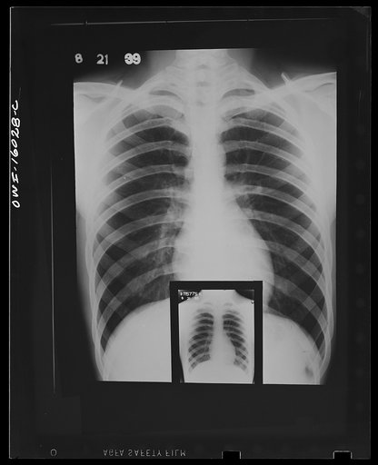 Detroit, Michigan. New method of making x-ray photographs size 4x5 inches instead of larger. Used at the Herman Kiefer Hospital for Communicable Diseases to show various stages of tuberculosis