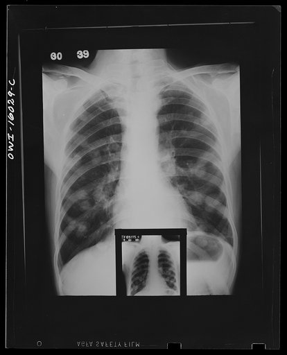 Untitled photo, possibly related to: Detroit, Michigan. New method of making x-ray photographs size 4x5 inches instead of larger. Used at the Herman Kiefer Hospital for Communicable Diseases to show various stages of tuberculosis