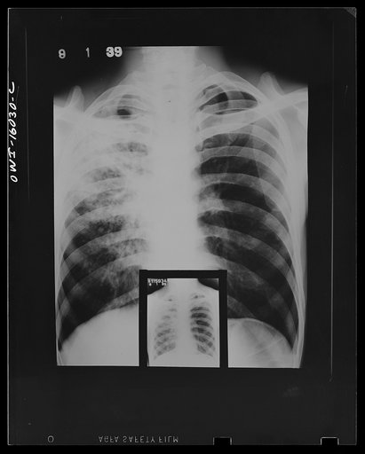 Untitled photo, possibly related to: Detroit, Michigan. New method of making x-ray photographs size 4x5 inches instead of larger. Used at the Herman Kiefer Hospital for Communicable Diseases to show various stages of tuberculosis