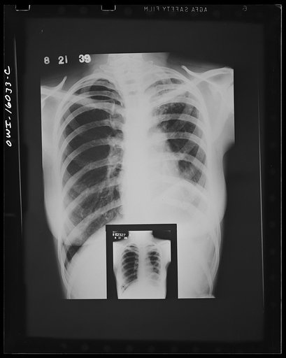 Untitled photo, possibly related to: Detroit, Michigan. New method of making x-ray photographs size 4x5 inches instead of larger. Used at the Herman Kiefer Hospital for Communicable Diseases to show various stages of tuberculosis