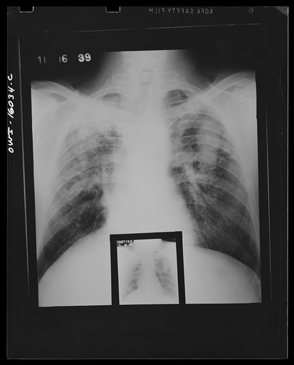 Untitled photo, possibly related to: Detroit, Michigan. New method of making x-ray photographs size 4x5 inches instead of larger. Used at the Herman Kiefer Hospital for Communicable Diseases to show various stages of tuberculosis