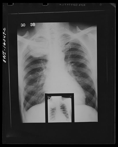 Detroit, Michigan. New method of making x-ray photographs size 4x5 inches instead of larger. Used at the Herman Kiefer Hospital for Communicable Diseases to show various stages of tuberculosis. X-ray photograph of active tuberculosis condition