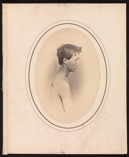 Private Jacob F. Simmons, Company H, Eighty-second Pennsylvania Volunteers