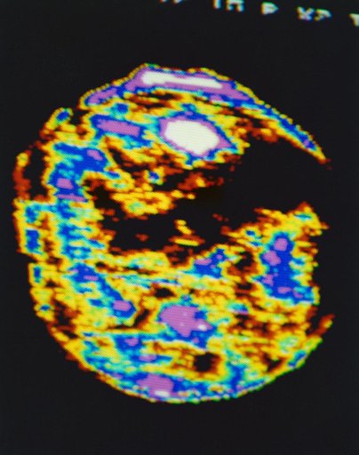 View of coronal hole processed from television transmission of ATM