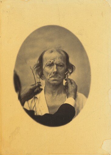Plate 14: Designed to show a comparison between the maximal contraction of the superior part of m. orbicularis oculi and m. corrugator supercilii, in the same individual. On the left, very strong electrization of the superior part of m. orbicularis oculi: dissatisfaction, somber thoughts. On the right, electrization of m. corrugator supercilii.