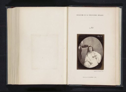 Portrait of G.B.A. Duchenne and test subject 'Lady Macbeth' during electrostimulation