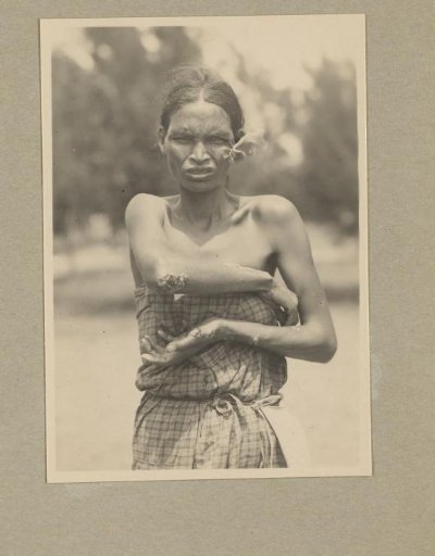 Woman with yaws
