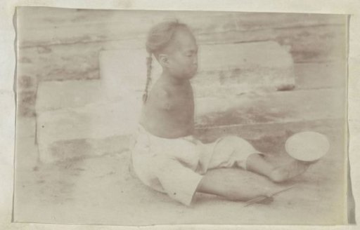 Chinese Child Without Arms Holding a Bowl and Eating Utensils with Feet