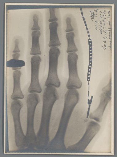 Hand with ring on the little finger