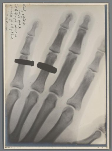 Left hand with rings on the ring finger and little finger