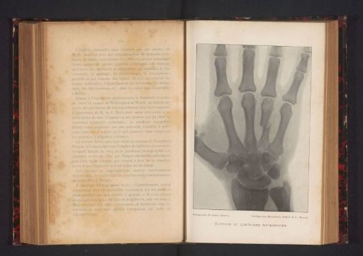 X-ray of a hand with a broken metacarpal bone