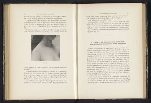 Hemorrhages on the neck of a woman