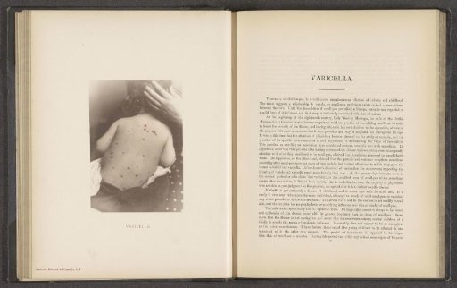 Patient suffering from the skin disease 'varicella'