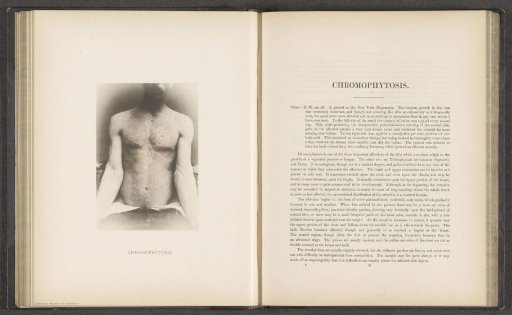 Patient suffering from the skin disease 'chromophytosis'