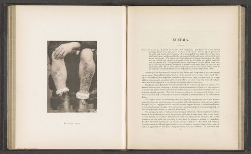 Patient suffering from the skin disease 'eczema cruris'