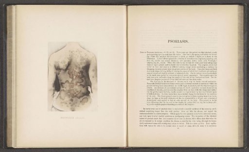 Patient suffering from the skin disease 'psoriasis annulata'