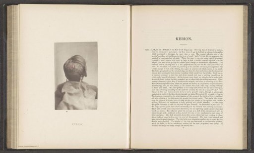 Patient suffering from the skin disease 'kerion'