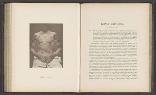 Patient suffering from the skin disease 'lepra maculosa'