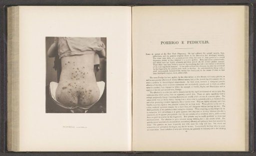 Patient suffering from the skin disease 'porrigo e pediculis'