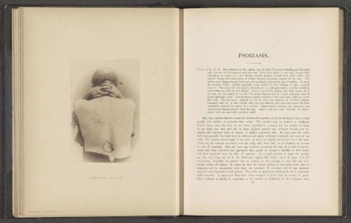 Patient suffering from the skin disease 'psoriasis nummulata'