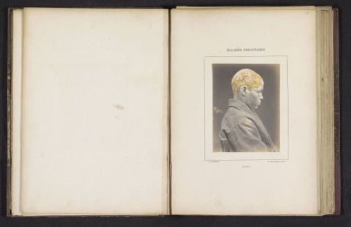 Portrait of an unknown man suffering from favus on the head