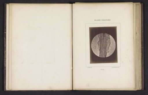 Microscopic image of the disease favus
