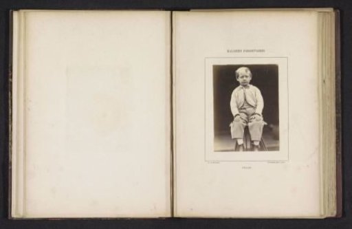 Portrait of an unknown boy suffering from alopecia areata