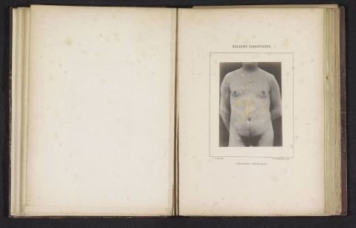 Man Suffering from Pityriasis Versicolor on His Torso