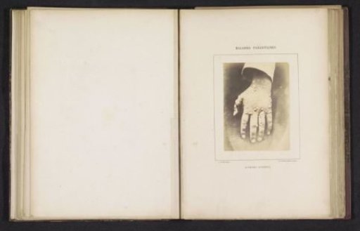 Hand with Scabby Ecthyma