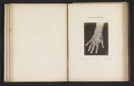 Hand of Someone Suspected of Suffering from Lichen Planus