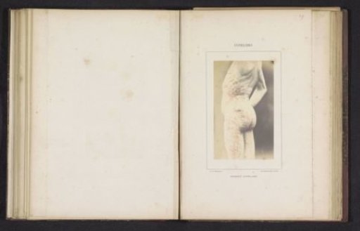 Ring-shaped skin rash caused by syphilis