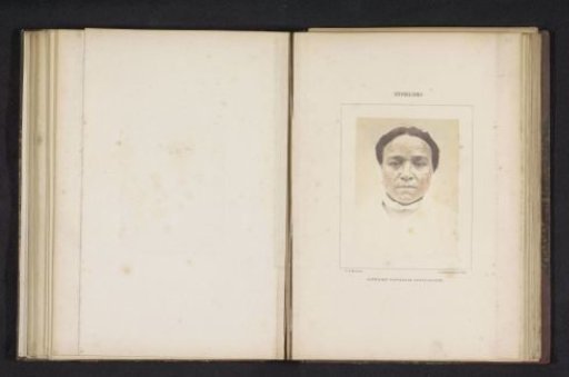 Skin rash caused by syphilis