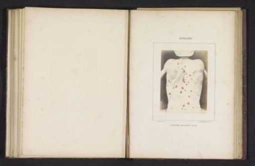 Skin rash caused by syphilis