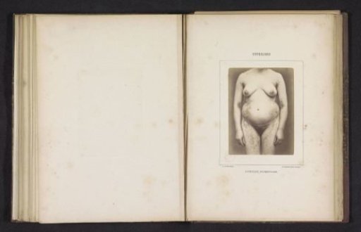 Woman with pigmented skin rash caused by syphilis