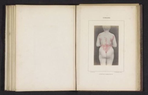 Woman with a rash caused by syphilis