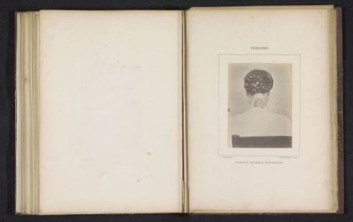 Woman with a rash on her neck caused by syphilis