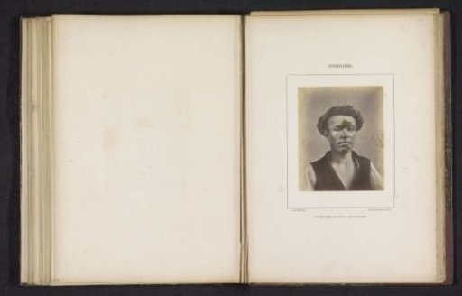 Portrait of an unknown man with a rash on his head caused by syphilis