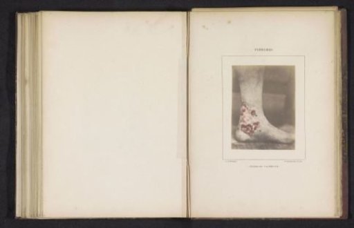 Ulcerating rash on a foot caused by syphilis