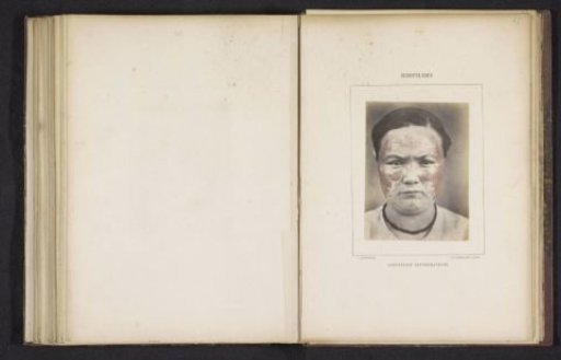 Portrait of an unknown woman with sores in her face, possibly caused by scrofula