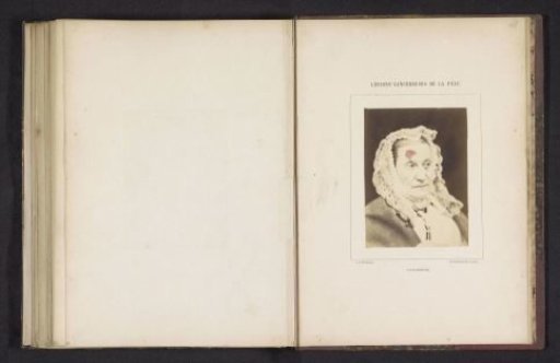 Portrait of an unknown woman with a tumor on her head caused by cancer